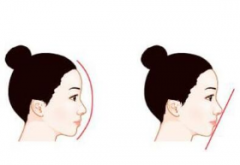 呼和浩特市玻尿酸隆鼻后能看出來(lái)嗎?