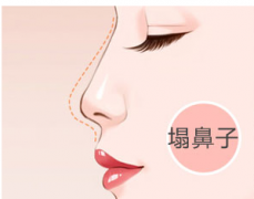 呼和浩特市玻尿酸隆鼻的維持時(shí)間是多久?