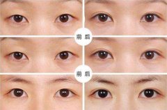 呼和浩特張高貴整形全面介紹埋線法重瞼術(shù)