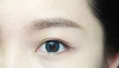 呼和浩特市雙眼皮手術(shù)恢復(fù)期大概要多久?