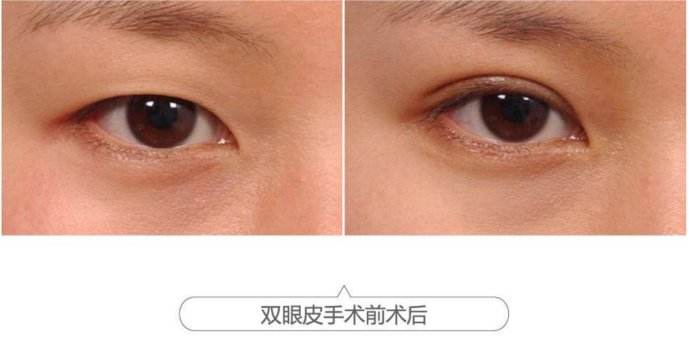 呼和浩特割雙眼皮哪家醫(yī)院好?