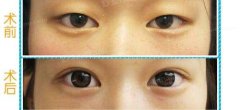 呼和浩特市眼部整形手術(shù)需要多少錢