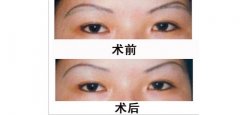 呼和浩特市哪家眼部整形醫(yī)院好