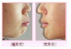 呼和浩特市哪間醫(yī)院做下巴整形比較好呢