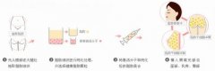 呼和浩特整形醫(yī)院自體脂肪填充有哪些優(yōu)勢?