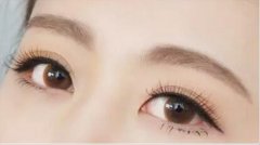 雙眼皮做完多久能做美瞳線?