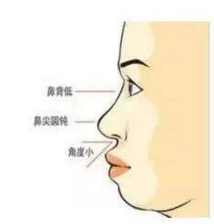 呼和浩特整形醫(yī)院做隆鼻后臉會變小嗎?