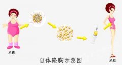 呼和浩特整形醫(yī)院自體脂肪隆胸效果怎么樣?