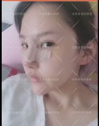 呼市鼻部整形鼻翼縮小好不好呢?