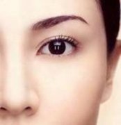 埋線雙眼皮好還是切開雙眼皮好?