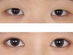 呼和浩特市整形醫(yī)院做開眼角手術(shù)多少錢?