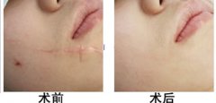 整形醫(yī)院激光去除疤痕的效果好嗎?