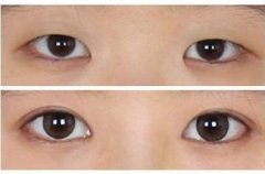 雙眼皮手術(shù)的注意事項(xiàng)有哪些?