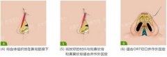 做韓式隆鼻的好處是什么?