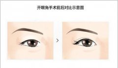 開眼角手術(shù)到底有什么好處呢?