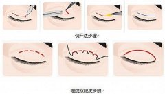 呼和浩特哪家做埋線雙眼皮效果好?
