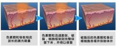 呼和浩特激光祛胎記多少錢?