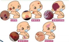 呼和浩特哪家醫(yī)院祛胎記好?