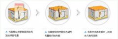 呼和浩特做激光脫唇毛多少錢(qián)?