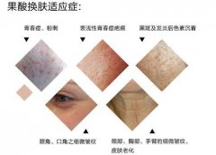 呼和浩特果酸換膚效果如何?