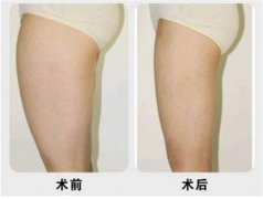 呼和浩特大腿抽脂得多少錢?