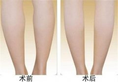 呼和浩特哪家醫(yī)院做腿部吸脂效果好?