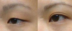 呼和浩特哪家醫(yī)院做雙眼皮整形效果好?