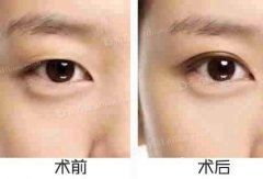 呼和浩特做全切雙眼皮多少錢(qián)?