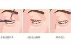 雙眼皮修復(fù)手術(shù)多少錢(qián)?