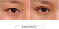 呼和浩特割雙眼皮多少錢(qián)?