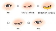 呼和浩特祛眼袋手術(shù)多少錢?