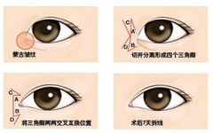 呼市開眼角手術(shù)會影響后遺癥嗎?