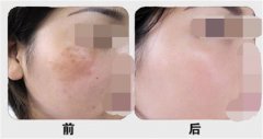 呼和浩特祛胎記大概多少錢?