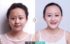 玻尿酸填充法令紋安全嗎?