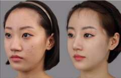 隆鼻后效果真實嗎?