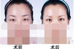 呼和浩特雙眼皮哪家醫(yī)院效果好?