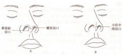 呼和浩特隆鼻手術(shù)會(huì)留疤痕嗎?