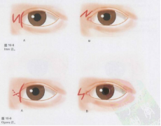 呼和浩特做內(nèi)眥贅皮矯正手術(shù)會痛嗎?