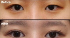 呼和浩特開眼角手術會損傷眼睛嗎?