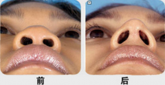 呼和浩特鼻尖整形大概多少錢?