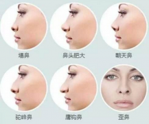 呼和浩特隆鼻后呼吸不通暢怎么辦?