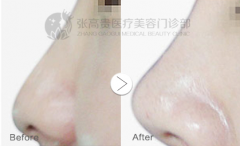 呼和浩特整形注射隆鼻安全嗎?