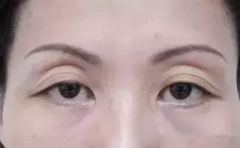 呼市整形眼窩凹陷該如何呢?