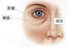 呼和浩特整形臥蠶與眼袋的區(qū)別?