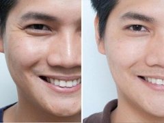 呼市整形瑞藍(lán)玻尿酸是怎樣去除魚尾紋的?