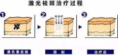 哪些方法是快速去雀斑的呢?