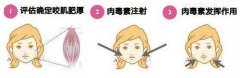 注射瘦臉針的價格需要多少錢呢?