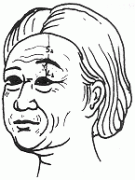 半年前做的自體脂肪面部填充,竟然開始下垂?