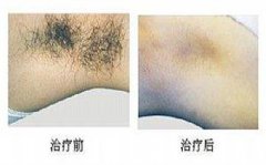 激光脫腋毛有哪些優(yōu)勢(shì)呢?