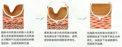 如何快速有效的祛痘呢?